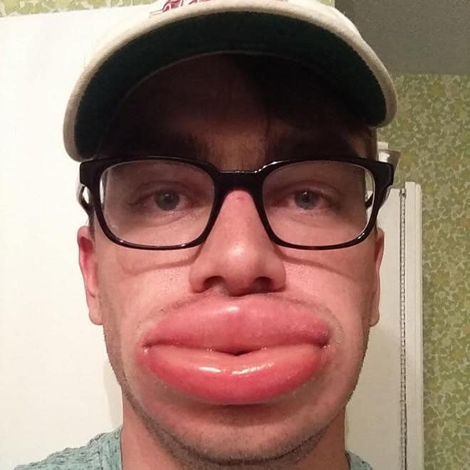 People after bee stings look like they found a natural and cheap alternative to collagen lip filler