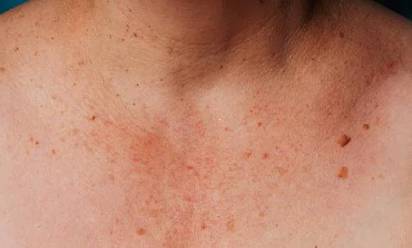 Read carefully if red spots appear on your skin!